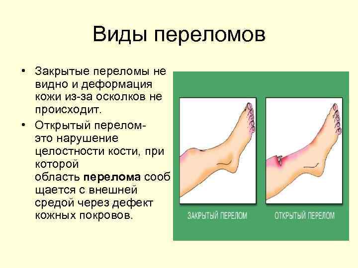 Виды переломов презентация