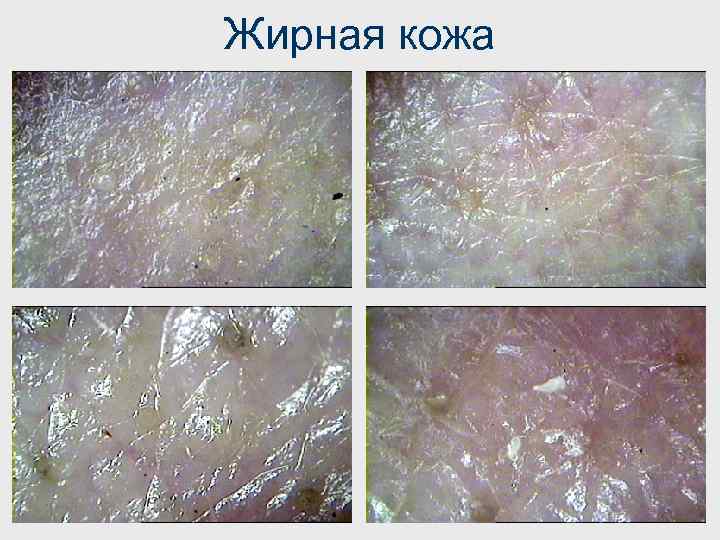 Жирная кожа 
