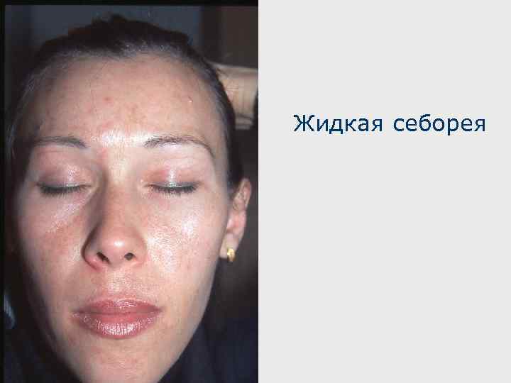 Жидкая себорея 