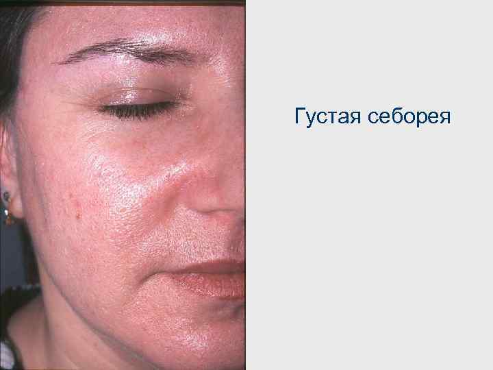 Густая себорея 