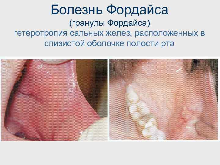 Болезнь Фордайса (гранулы Фордайса) гетеротропия сальных желез, расположенных в слизистой оболочке полости рта 