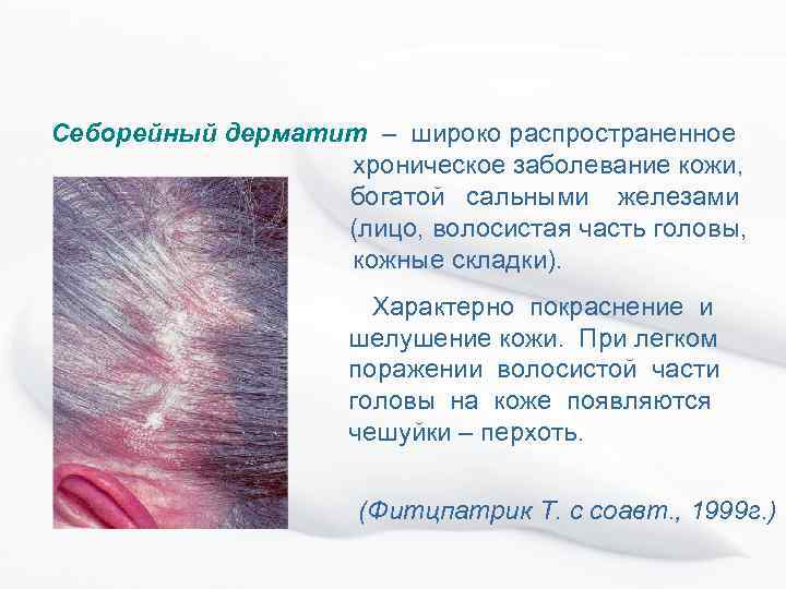 Себорейный дерматит – широко распространенное хроническое заболевание кожи, богатой сальными железами (лицо, волосистая часть