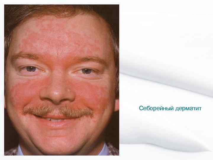 Себорейный дерматит 