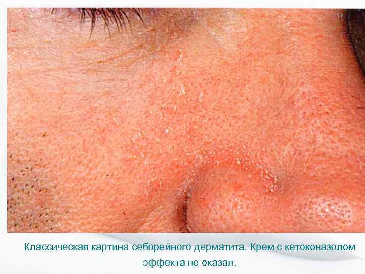 Классическая картина себорейного дерматита. Крем с кетоконазолом эффекта не оказал. 