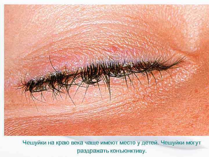 Чешуйки на краю века чаще имеют место у детей. Чешуйки могут раздражать конъюнктиву. 