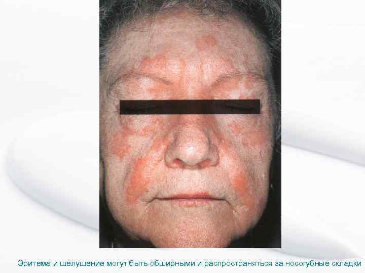 Эритема и шелушение могут быть обширными и распространяться за носогубные складки 