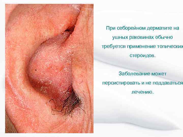 При себорейном дерматите на ушных раковинах обычно требуется применение топических стероидов. Заболевание может персистировать