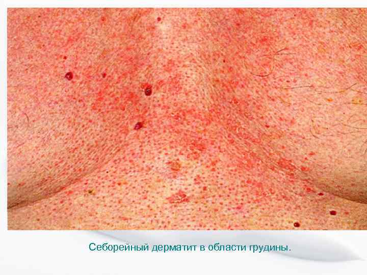 Себорейный дерматит в области грудины. 