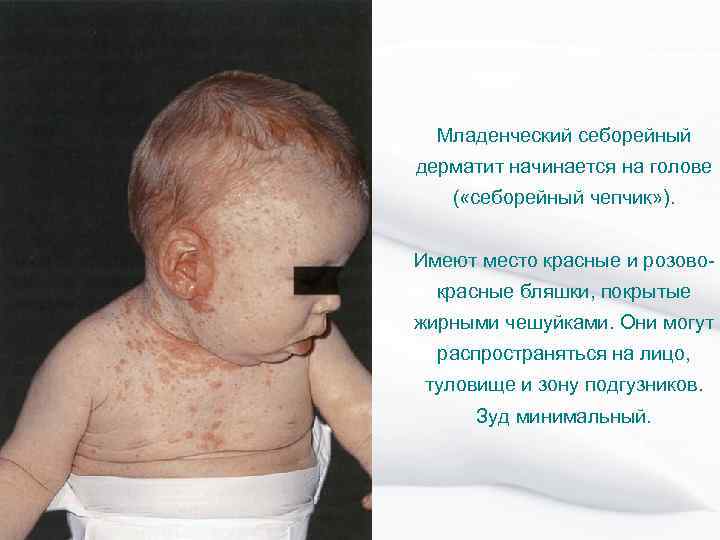 Младенческий себорейный дерматит начинается на голове ( «себорейный чепчик» ). Имеют место красные и