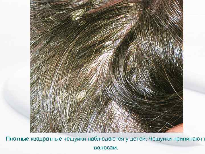Плотные квадратные чешуйки наблюдаются у детей. Чешуйки прилипают к волосам. 
