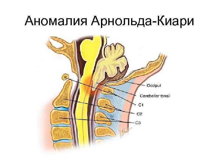 Аномалия Арнольда-Киари 