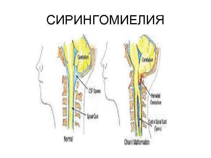 СИРИНГОМИЕЛИЯ 