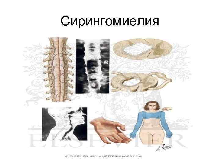 Сирингомиелия 