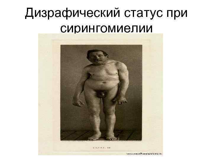 Дизрафический статус при сирингомиелии 