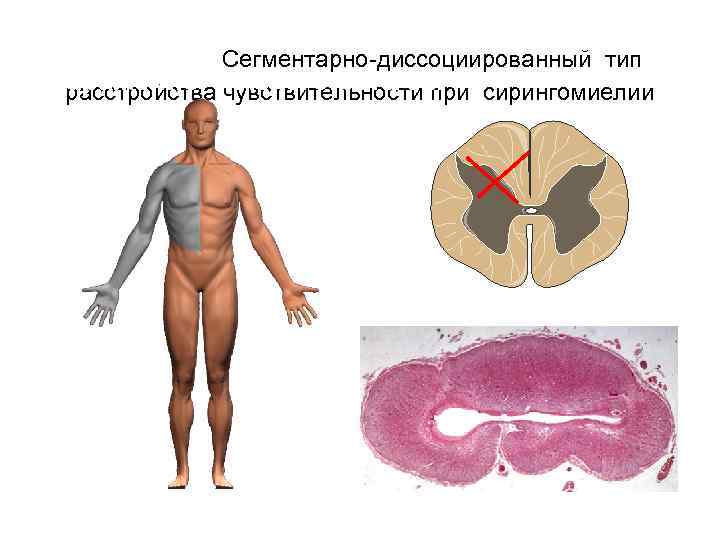 Сегментарно-диссоциированный тип Поражение чччзаего рога см сирингомиелии расстройства чувствительности при Часто 