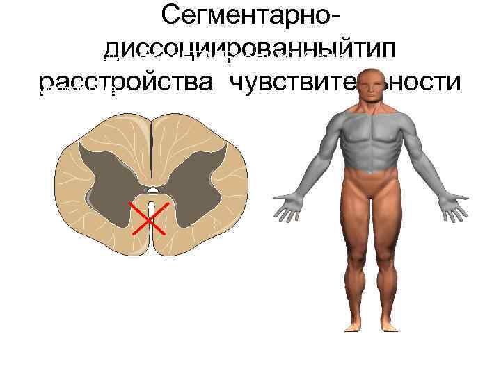 Сегментарнодиссоциированныйтип Поражение перс. ЕГМЕседней белр расстройства чувствительности сегментарные диссоциированные расстройства чувствительности, но в этом
