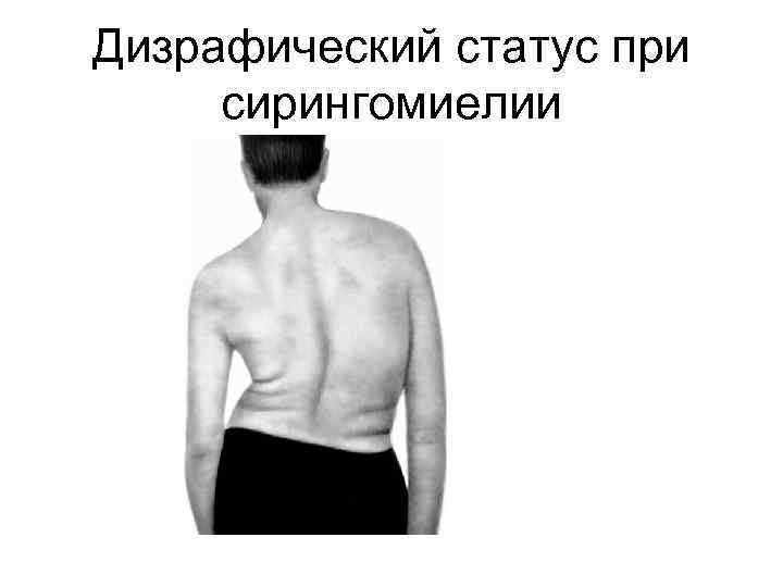 Дизрафический статус при сирингомиелии 