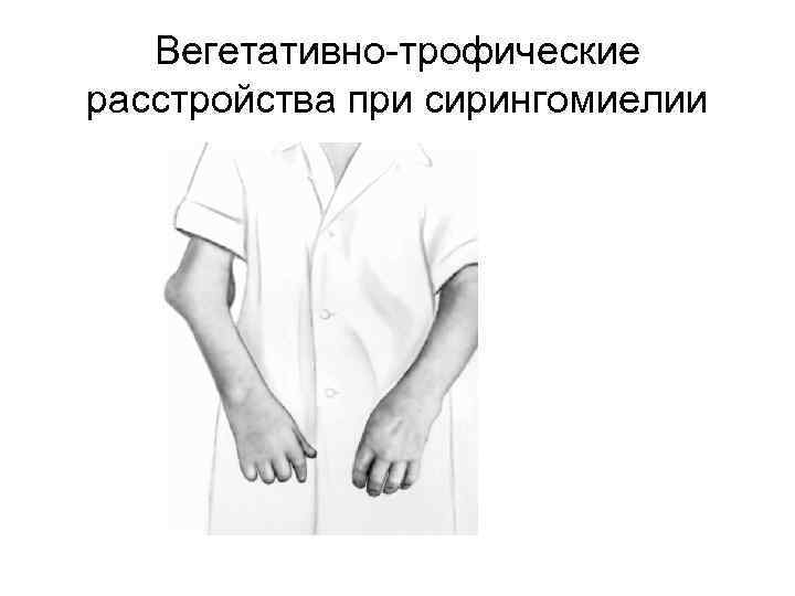 Вегетативно-трофические расстройства при сирингомиелии 