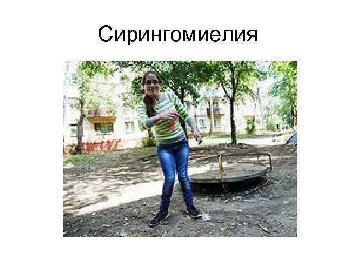 Сирингомиелия 