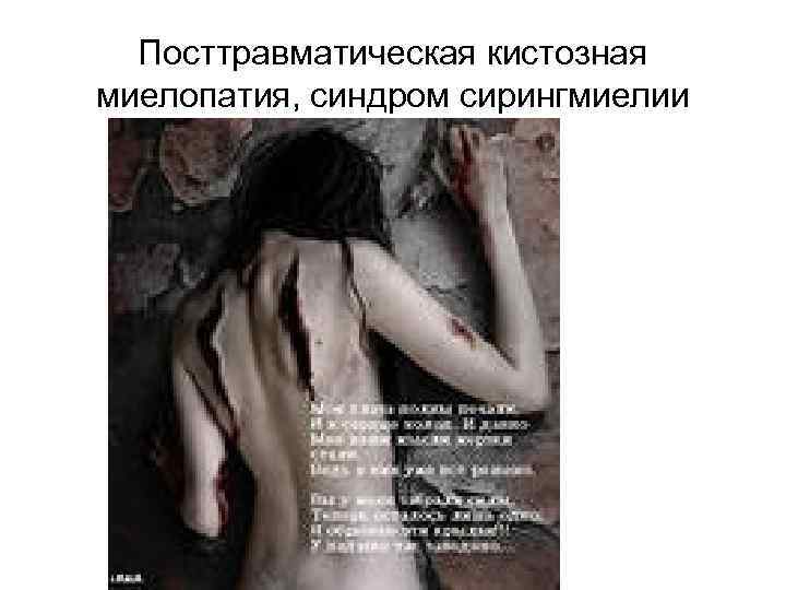 Посттравматическая кистозная миелопатия, синдром сирингмиелии 