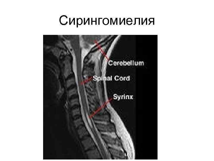 Сирингомиелия 