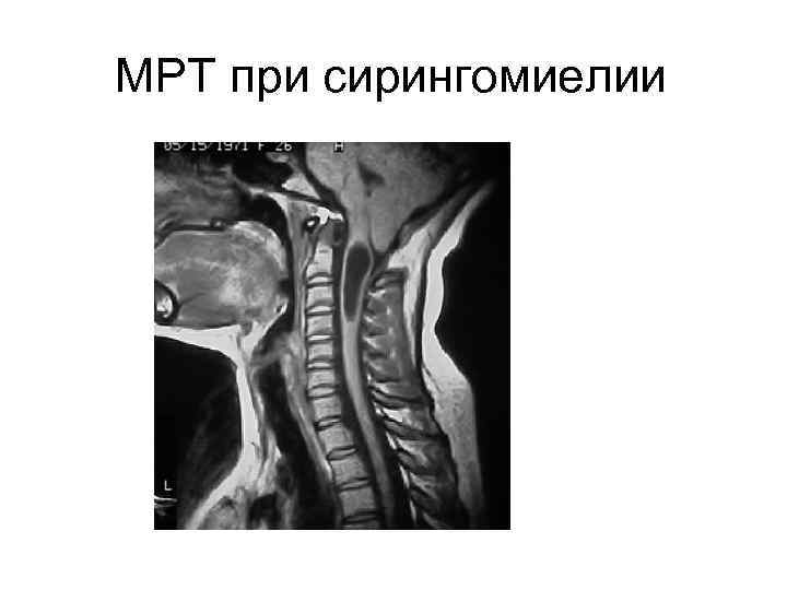 МРТ при сирингомиелии 