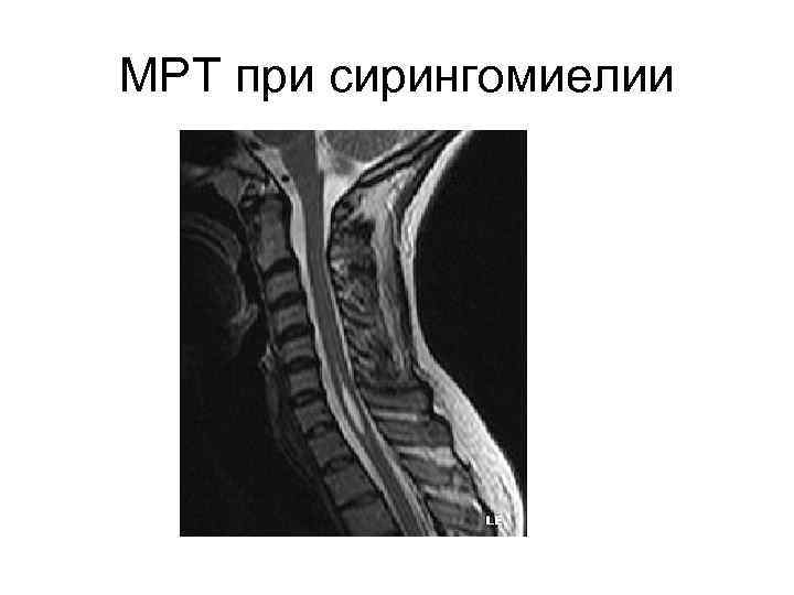 МРТ при сирингомиелии 
