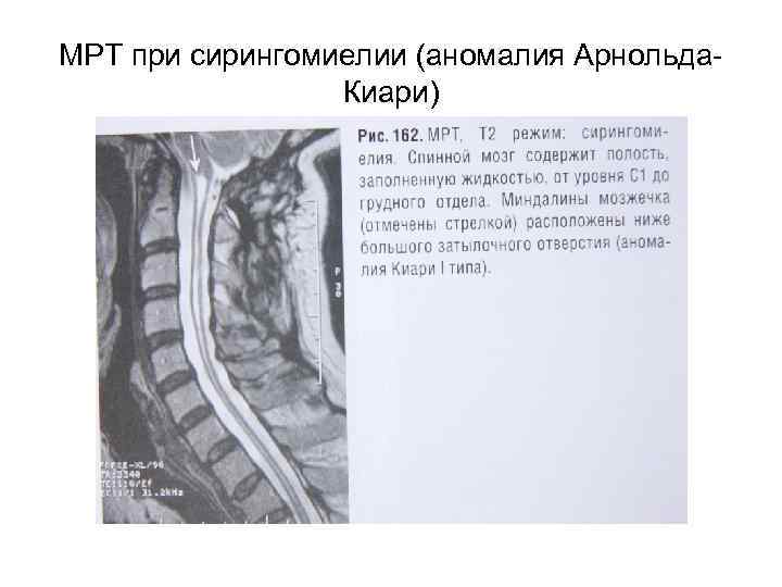 МРТ при сирингомиелии (аномалия Арнольда. Киари) 
