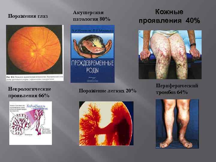 Поражения глаз Неврологические проявления 66% Акушерская патология 80% Поражение легких 20% Кожные проявления 40%