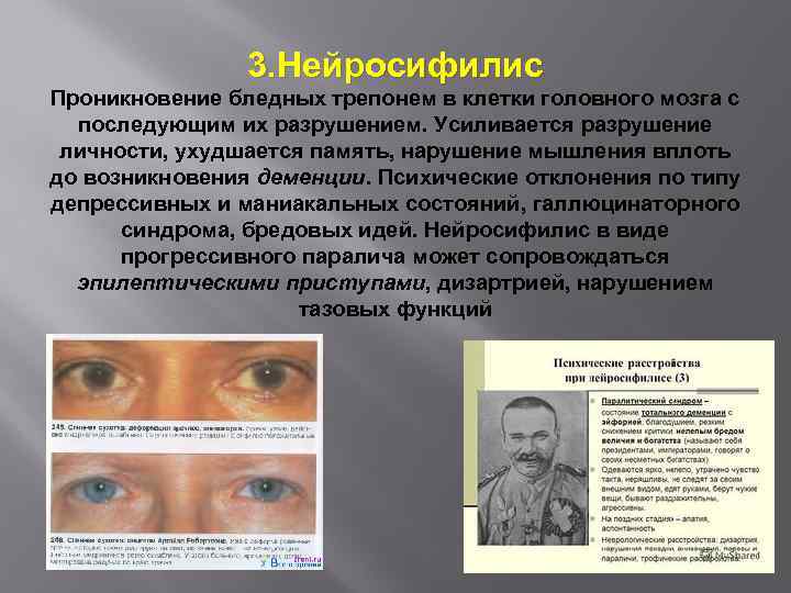 3. Нейросифилис Проникновение бледных трепонем в клетки головного мозга с последующим их разрушением. Усиливается