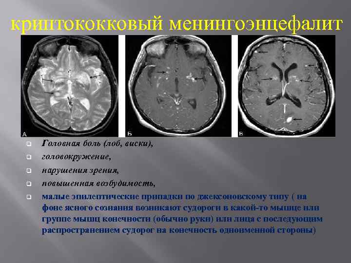 План обследования менингоэнцефалит