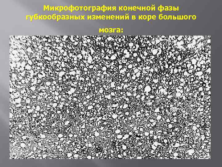Микрофотография конечной фазы губкообразных изменений в коре большого мозга: 