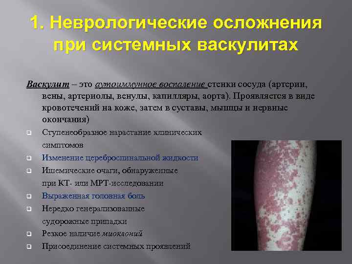 1. Неврологические осложнения при системных васкулитах Васкулит – это аутоиммунное воспаление стенки сосуда (артерии,