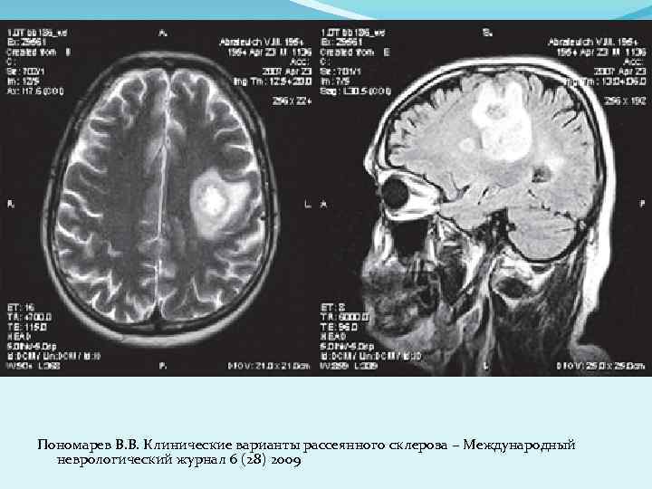 Пономарев В. В. Клинические варианты рассеянного склероза − Международный неврологический журнал 6 (28) 2009
