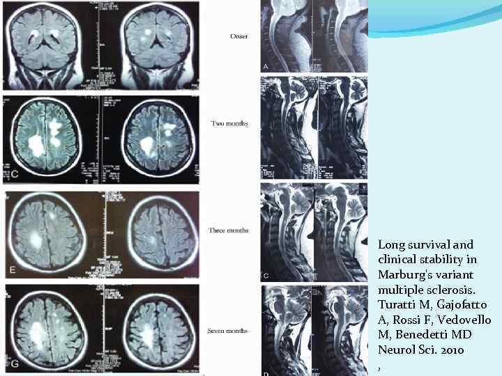 Long survival and clinical stability in Marburg's variant multiple sclerosis. Turatti M, Gajofatto A,