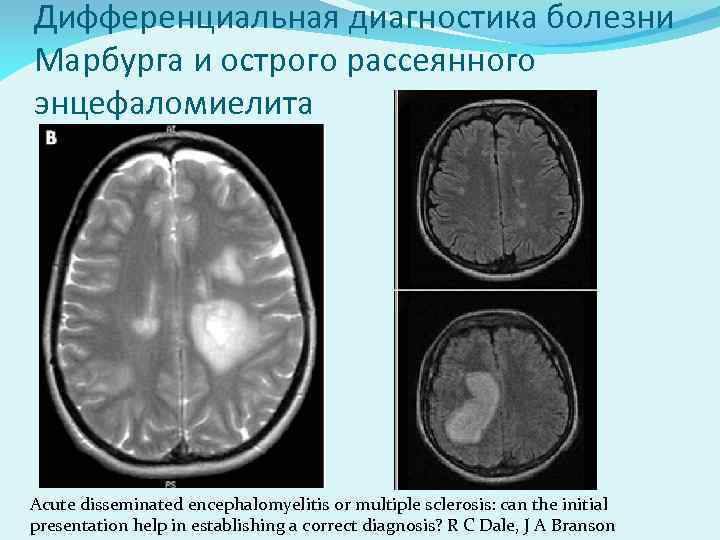 Дифференциальная диагностика болезни Марбурга и острого рассеянного энцефаломиелита Acute disseminated encephalomyelitis or multiple sclerosis: