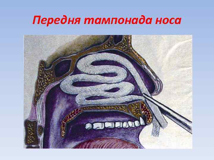 Передня тампонада носа 