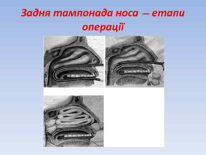 Задня тампонада носа — етапи операції 