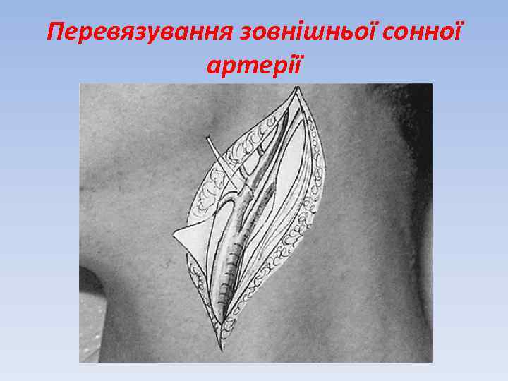 Перевязування зовнішньої сонної артерії 