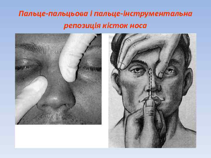 Пальце-пальцьова і пальце-інструментальна репозиція кісток носа 