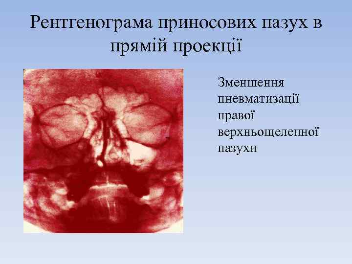Рентгенограма приносових пазух в прямій проекції Зменшення пневматизації правої верхньощелепної пазухи 