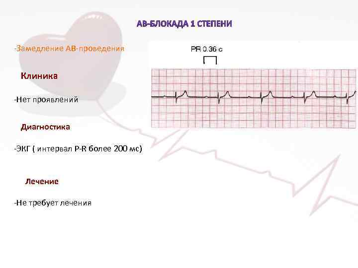 -Замедление АВ-проведения Клиника -Нет проявлений Диагностика -ЭКГ ( интервал P-R более 200 мс) Лечение