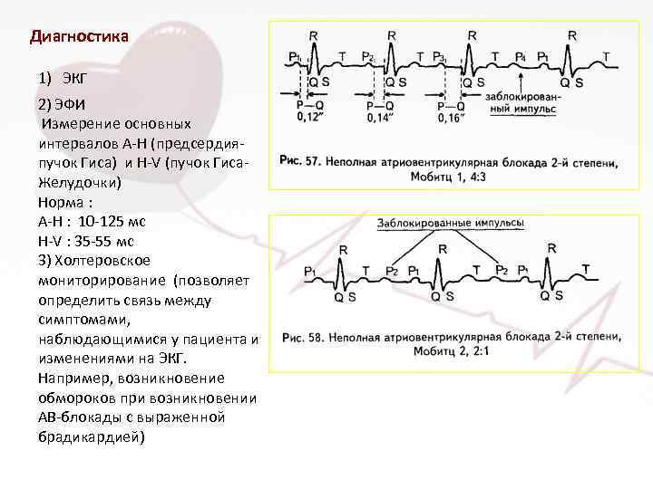 Диагностика 1) ЭКГ 2) ЭФИ Измерение основных интервалов A-H (предсердияпучок Гиса) и H-V (пучок