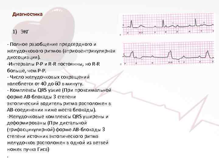 Диагностика 1) ЭКГ - Полное разобщение предсердного и желудочкового ритмов (атриовентрикулярная диссоциация). -Интервалы P-P