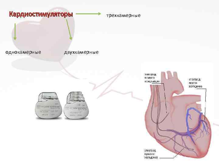 Кардиостимуляторы однокамерные двухкамерные трехкамерные 