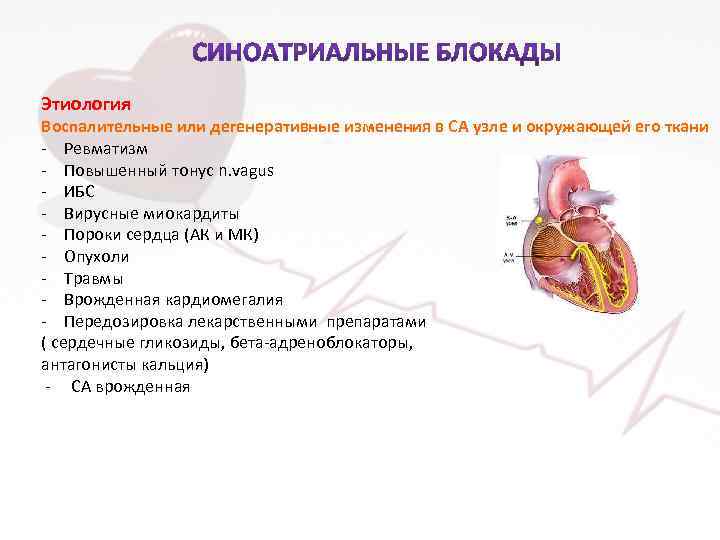 Этиология Воспалительные или дегенеративные изменения в СА узле и окружающей его ткани - Ревматизм