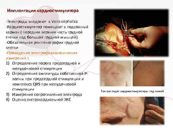 Имплантация кардиостимулятора -Электроды внедряют в Vena cephalica -Кардиостимулятор помещают в подкожный карман ( передняя