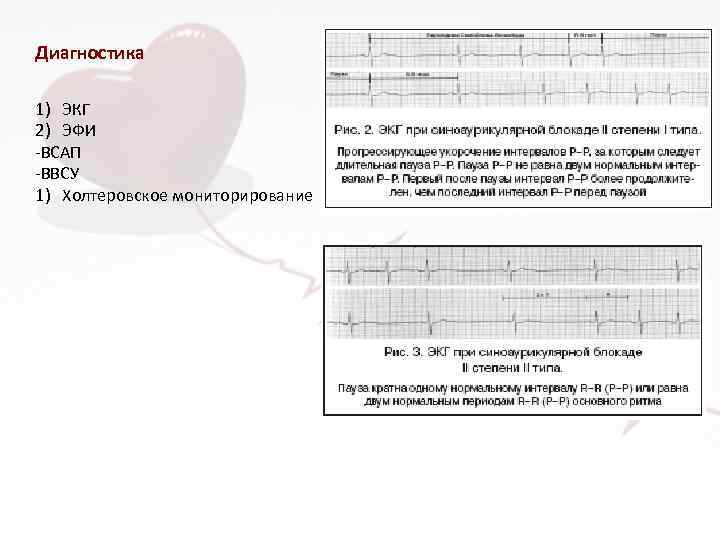 Диагностика 1) ЭКГ 2) ЭФИ -ВСАП -ВВСУ 1) Холтеровское мониторирование 