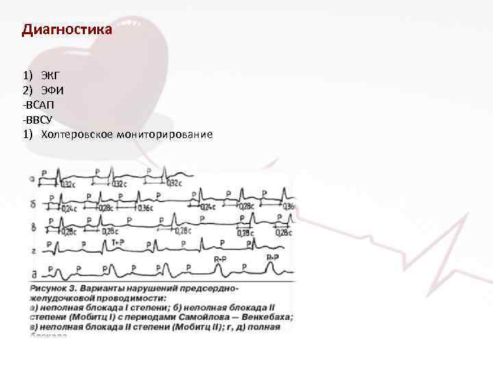 Диагностика 1) ЭКГ 2) ЭФИ -ВСАП -ВВСУ 1) Холтеровское мониторирование 