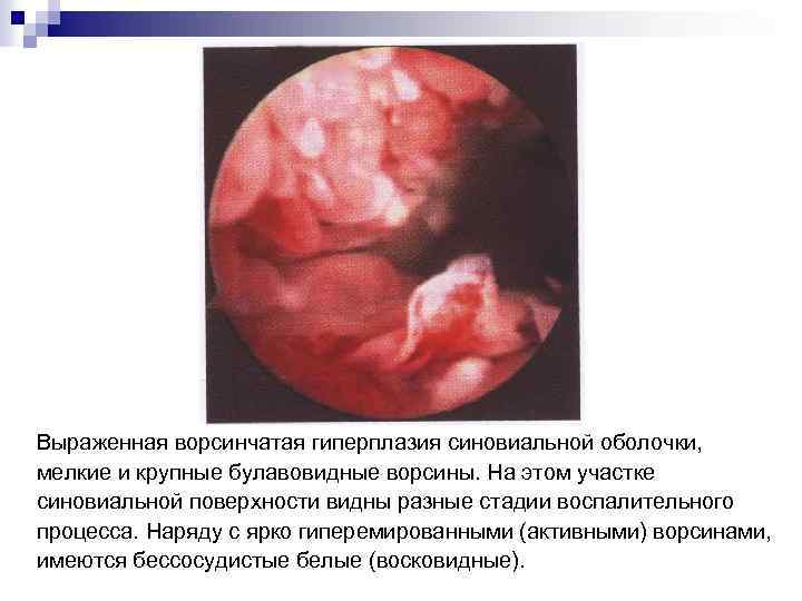 Выраженная ворсинчатая гиперплазия синовиальной оболочки, мелкие и крупные булавовидные ворсины. На этом участке синовиальной